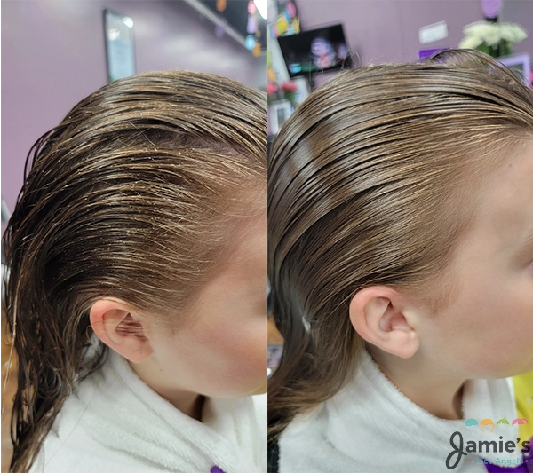 Before and after lice treatment, Left shows nits in hair, right shows hair free of nits