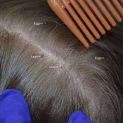 Head lice in the hair against scalp